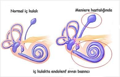 Meniere hastalığında iç kulak hasarını gösteren görsel.